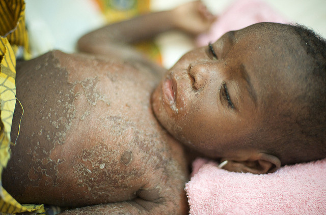 Tanganyika : la Zone de santé de Manono frappée par une épidémie de rougeole