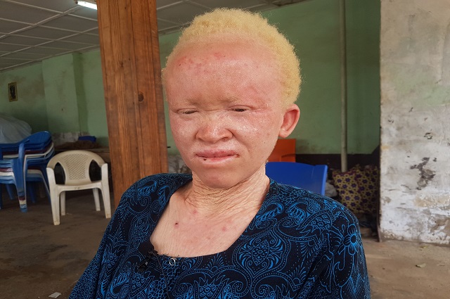 La galère des femmes albinos à Lubumbashi