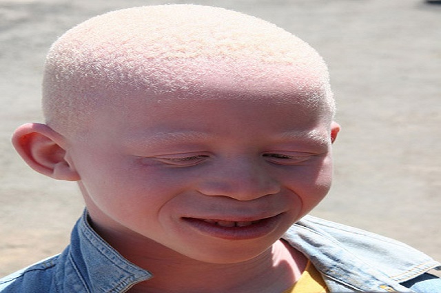 Haut- Katanga : 51 albinos décédés à cause  du cancer de la peau au cours de l’année 2018