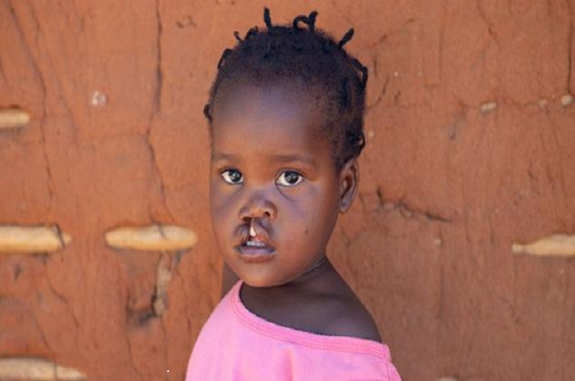 Lubumbashi : une cinquantaine de malades soignés gratuitement des fentes labiales et palatines