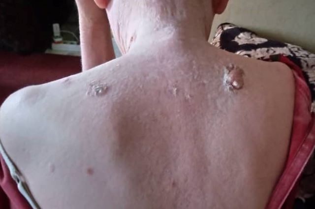 Lubumbashi : quand la mort devient une fatalité pour les albinos malades du cancer de la peau