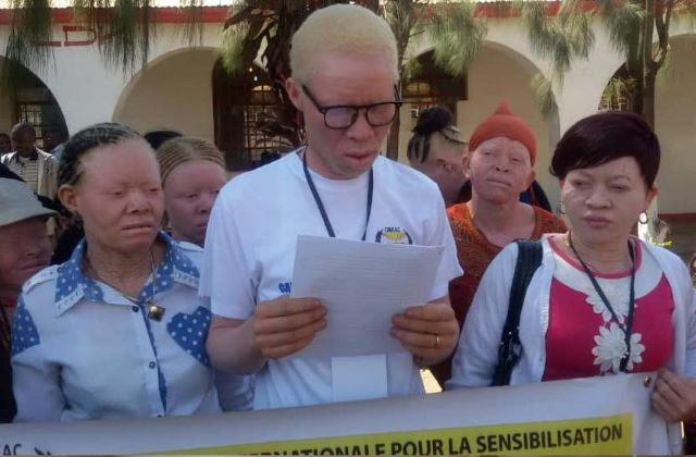 Lubumbashi : des étudiants albinos victimes du mépris