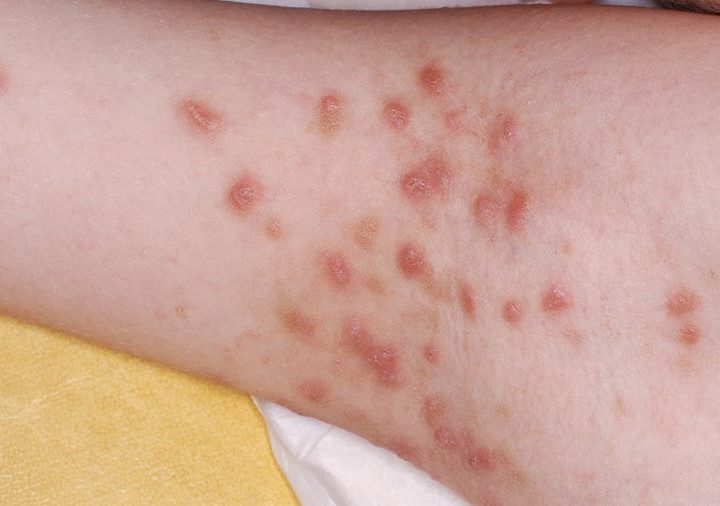 RDC: la gale, encore présente dans le milieu urbano-rural