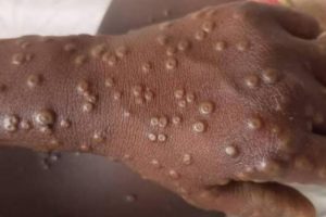 MPOX epidemie