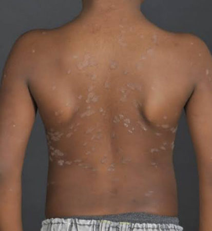 Lubumbashi: infections cutanées dues à la chaleur, quelle prise en charge