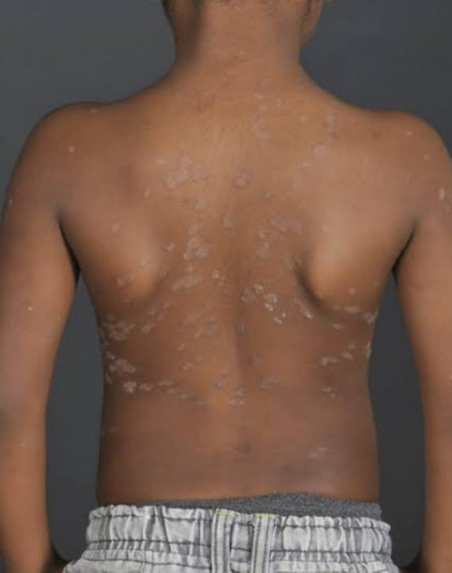 Lubumbashi: infections cutanées dues à la chaleur, quelle prise en charge