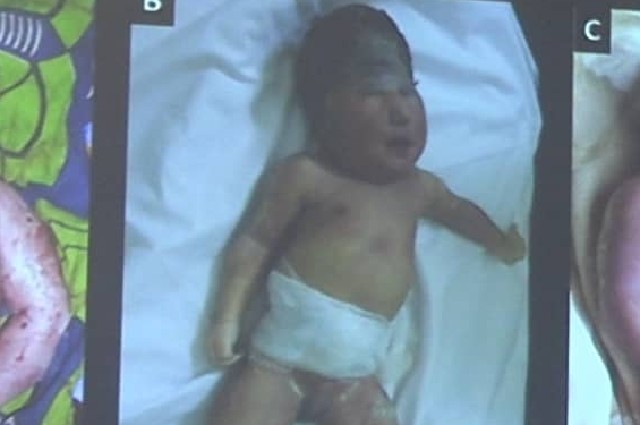 Les maladies imputables aux activités minières