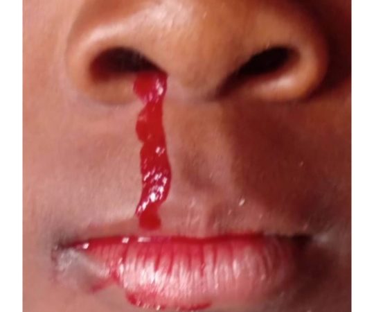 Kolwezi- pollution minière : 4 cas de saignements du nez à Dilungu