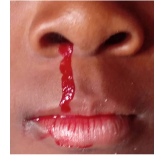 Kolwezi- pollution minière : 4 cas de saignements du nez à Dilungu